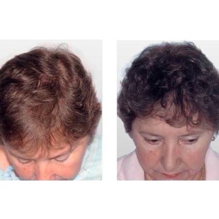 micro-hair-restoration-transplant-miami-carlos-spera-8