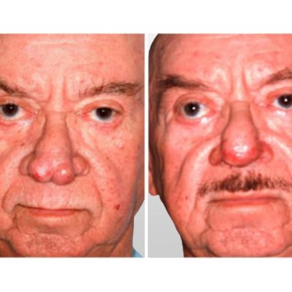 rhinophyma-miami-carlos-spera-2