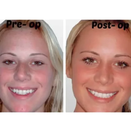 rhinoplasty-nose-surgery-miami-carlos-spera-32