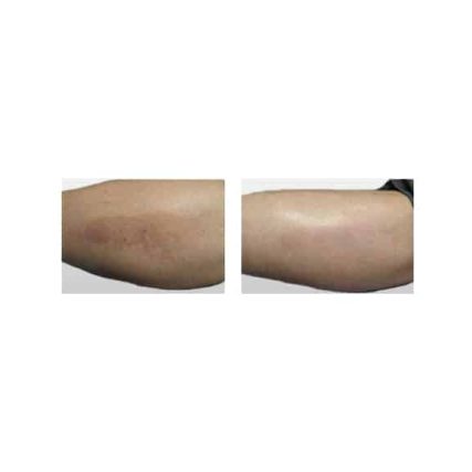 sciton-laser-skin-resurfacing-miami-carlos-spera-11