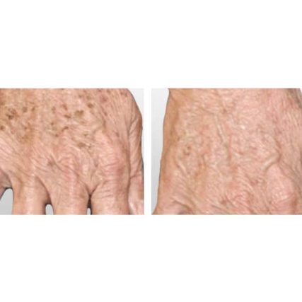sciton-laser-skin-resurfacing-miami-carlos-spera-14