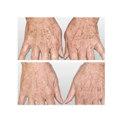 sciton-laser-skin-resurfacing-miami-carlos-spera-9