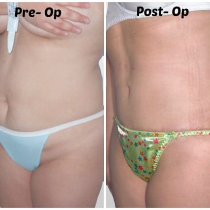 tummy-tuck-addominoplasty-miami-carlos-spera-20