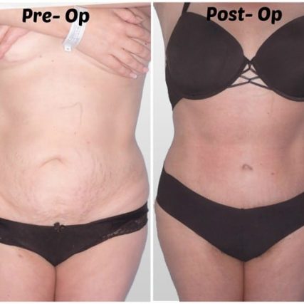 tummy-tuck-addominoplasty-miami-carlos-spera-25