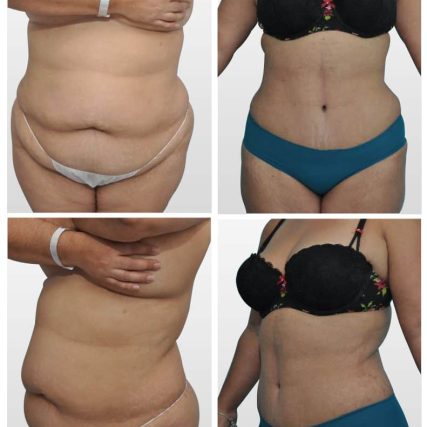tummy-tuck-addominoplasty-miami-carlos-spera-3